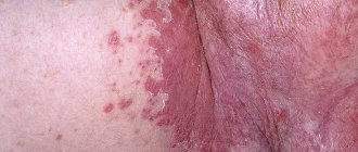 inflammation of the perineal area