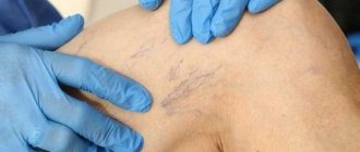 Doctors recommend using Anavenol to treat varicose veins