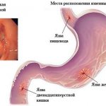 Duodenal ulcer: symptoms and treatment