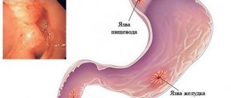 Duodenal ulcer: symptoms and treatment