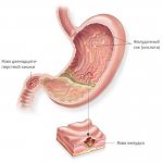 Stomach ulcer