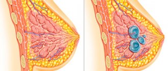healthy breast and adenoma