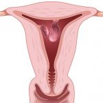 Железисто фиброзный полип эндоцервикса что это 1