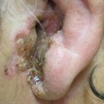 Malignant external otitis media. Narrowing of the ear canal, swelling of the auricle, large amounts of exudate 