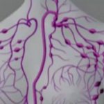 зоны поражения лимфомой